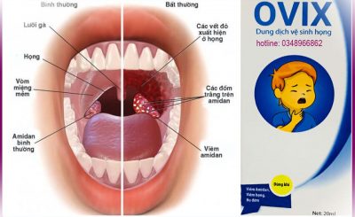 Xịt họng Ovix giải quyết các vấn đề về họng cho trẻ