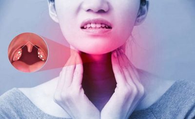 Viêm họng mãn tính điều trị và cách phòng bệnh